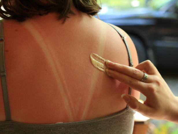 Soothe Sunburn with Manoynnaise Soothe Sunburn with Manoynnaise